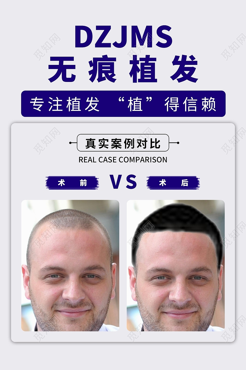 简约大气灰色系无痕植发海报宣传海报