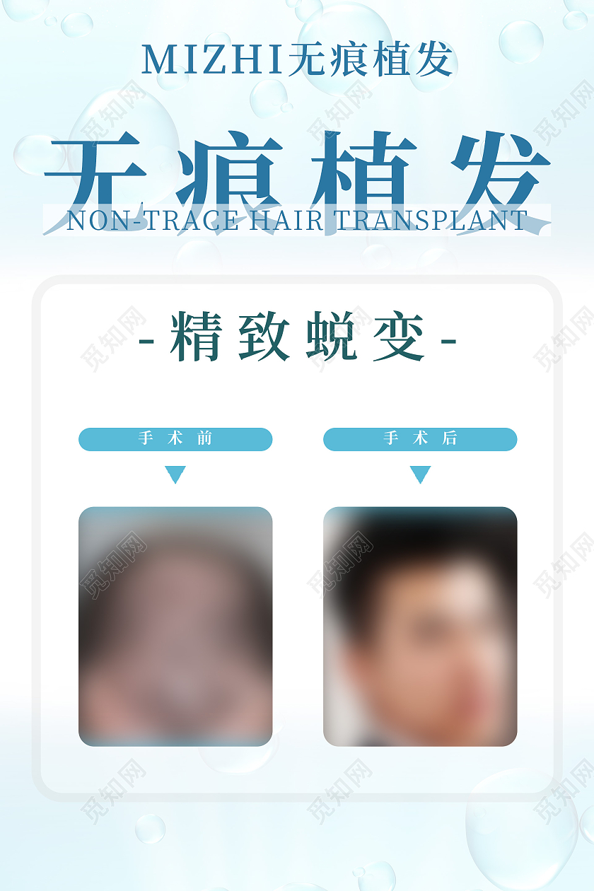 浅色简约无痕植发精致蜕变比对图宣传海报