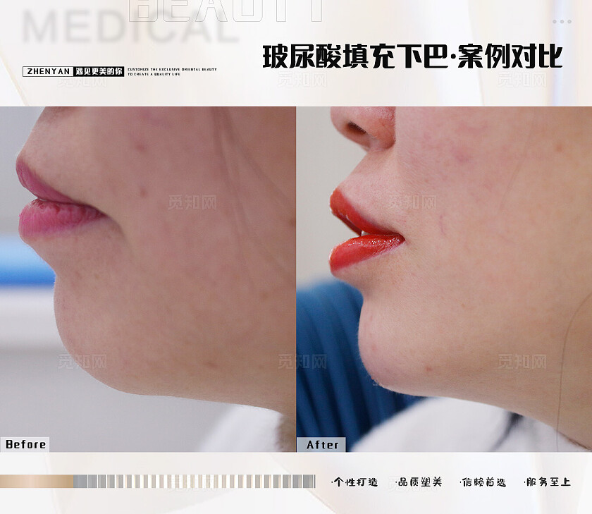 白色玻尿酸案例合集医美宣传海报