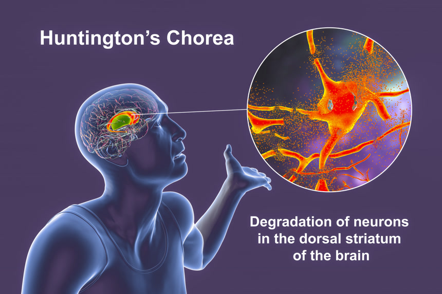 亨廷顿病患者大脑中突出的背侧纹状体尾状核和putamen以及神经元退化的特写医学医疗