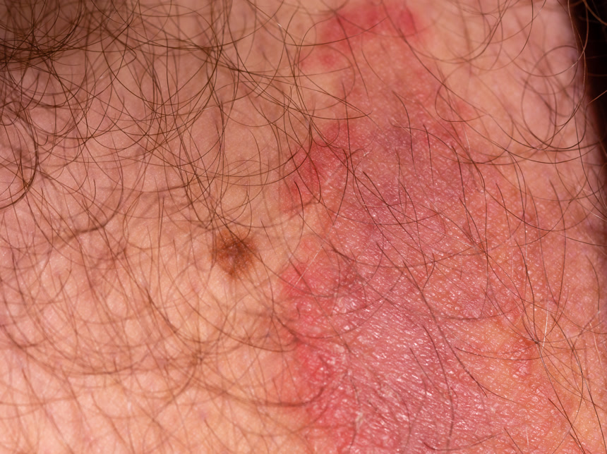 男性大腿真菌皮肤感染实物图