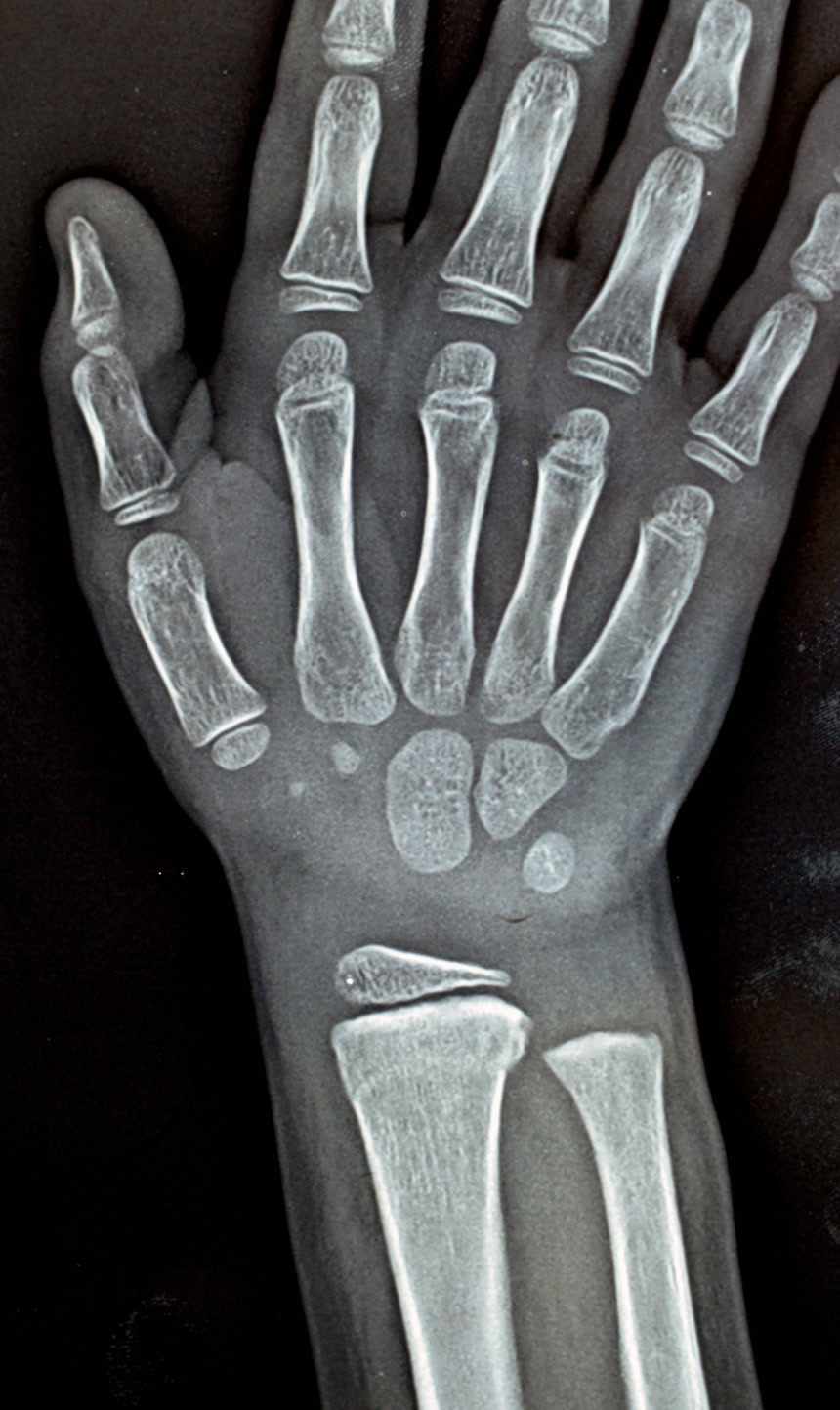 未成熟女童右腕关节PXR平片X线片显示病灶图医疗健康