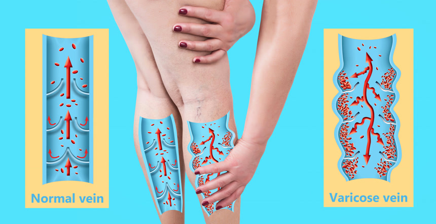 雌性长腿上的静脉曲张正常静脉和静脉曲张静脉的结构健康保健.