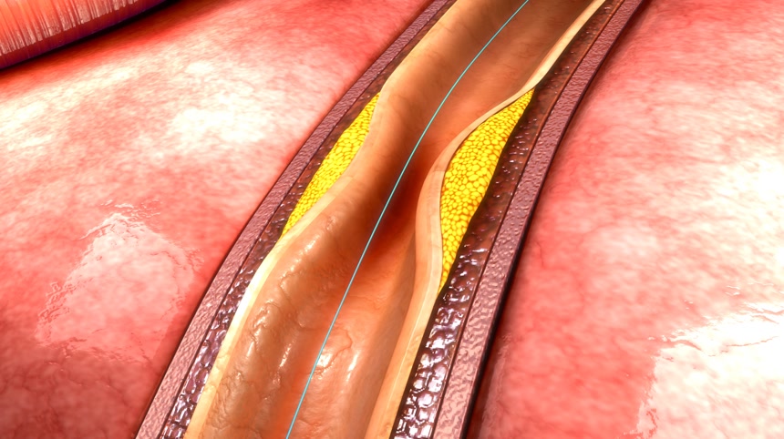 在人体血管支架医疗医学科技