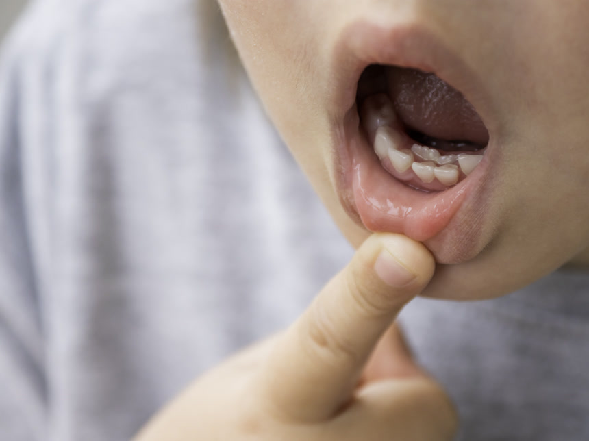 小孩子在他的月里表现出两排牙齿.在乳牙脱落之前,磨牙长了出来.牙医用牙龈的近照.医疗保健