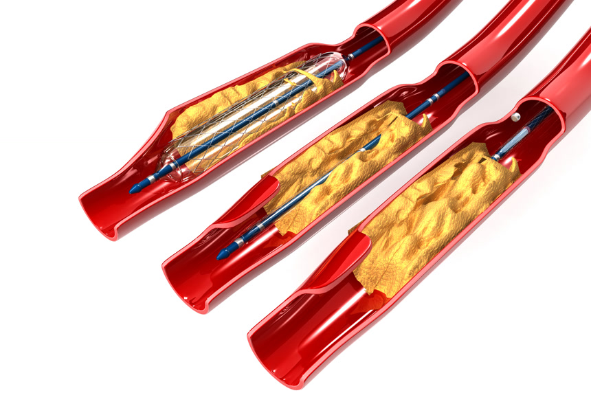 可伸缩支架解剖学概念医疗健康
