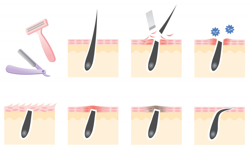 人体皮肤上毛发生长受损的美术宣传图