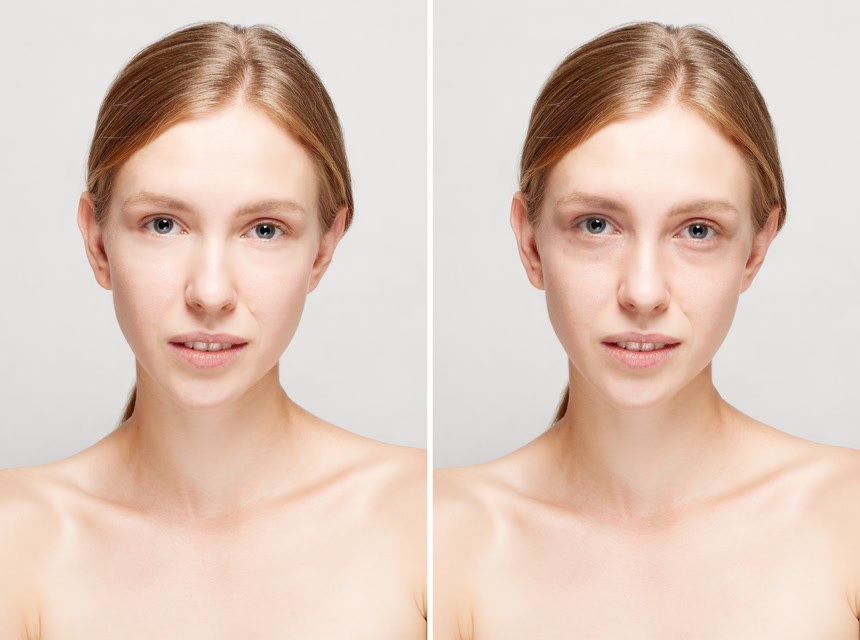 脸部整容前后对比图美容人像