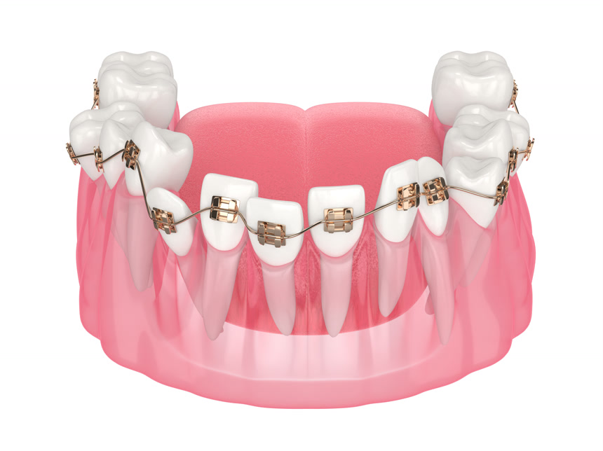 白色背景是牙齿矫正素材