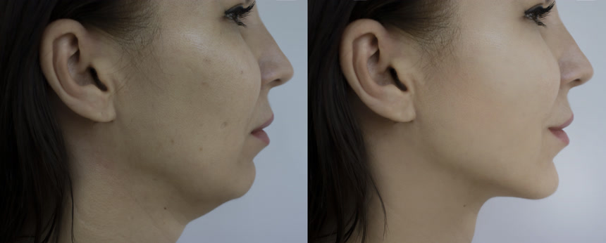 妇女在治疗前后面皱纹对比美容医美整形医院宣传