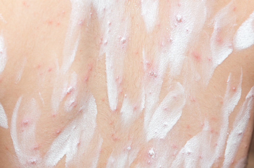 背部水痘皮疹涂上药膏皮肤病治疗医院