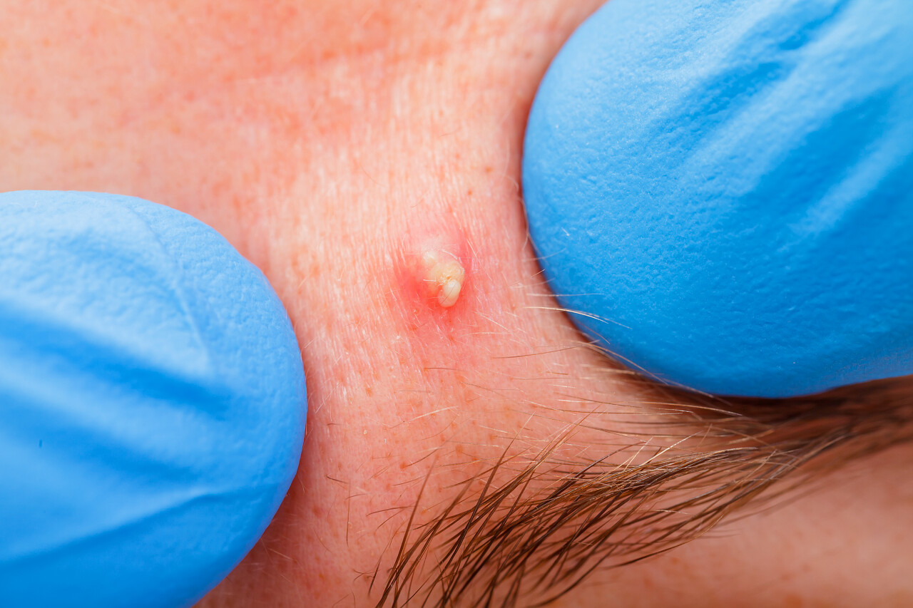 挤压到接种感染的痤疮