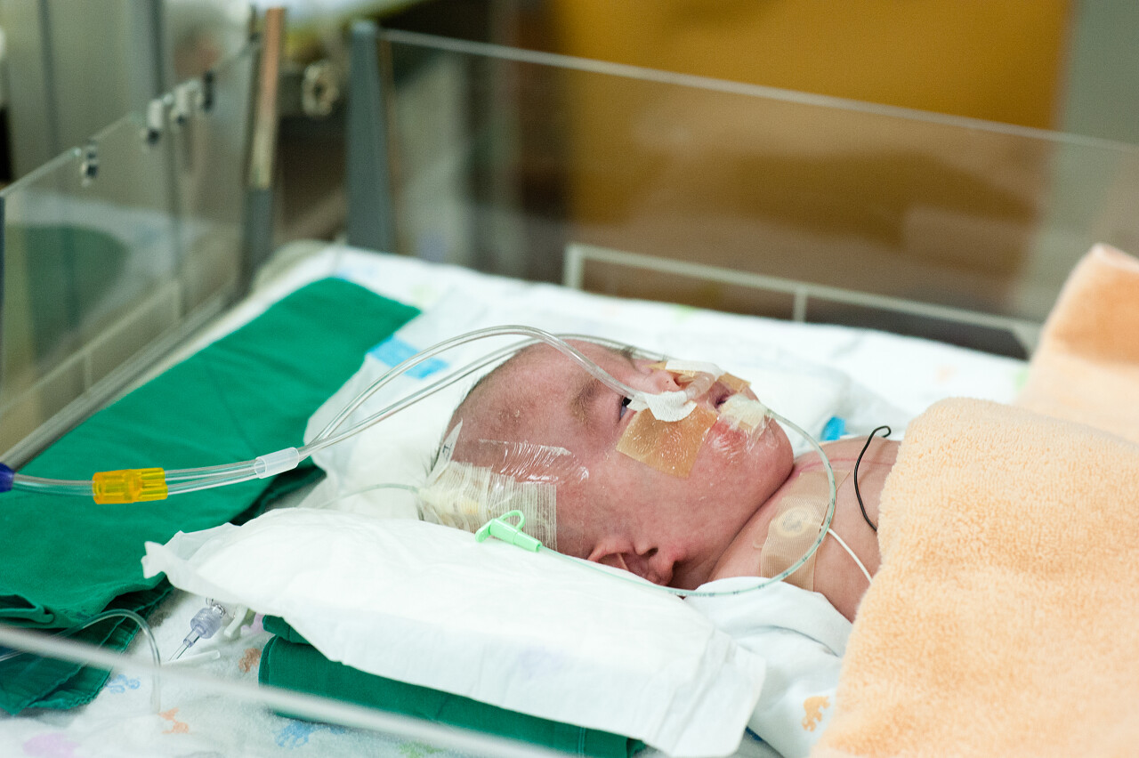 婴儿出生爱德华兹综合征