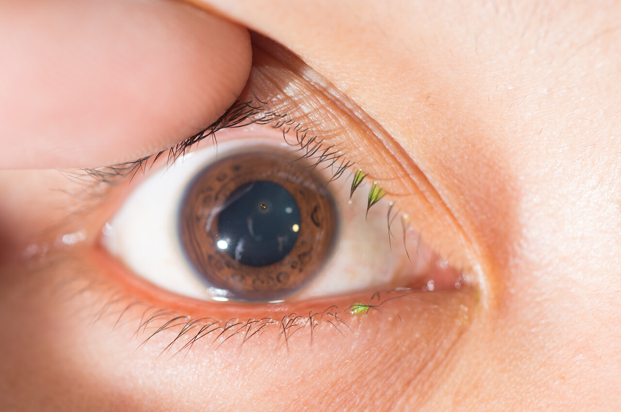 角膜的金属异物在眼科检查过程中关闭眼部整形