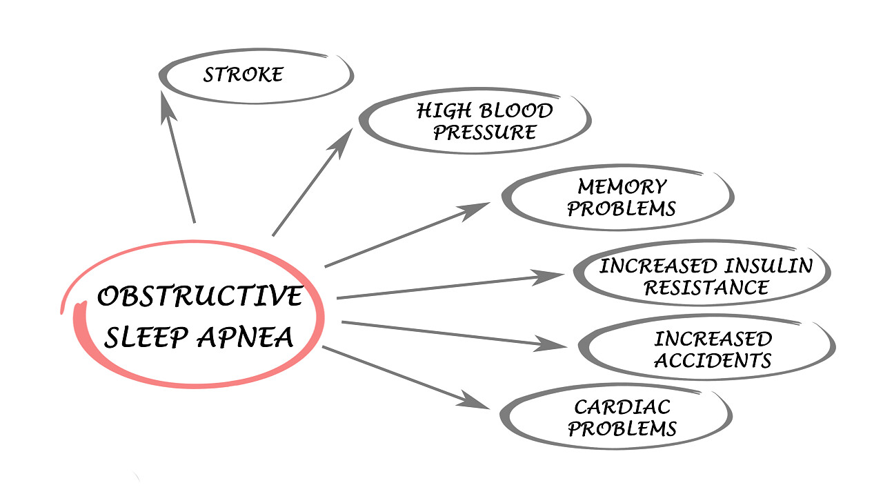 白色背景阻塞性睡眠呼吸暂停分析图