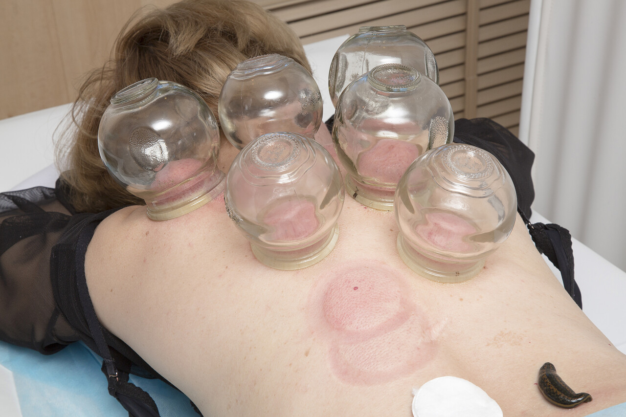 治疗椎间盘退行性疾病中医养生拔罐