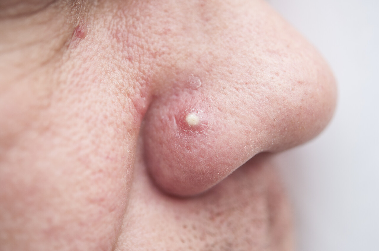 一个中年人的鼻子上有一个粉刺