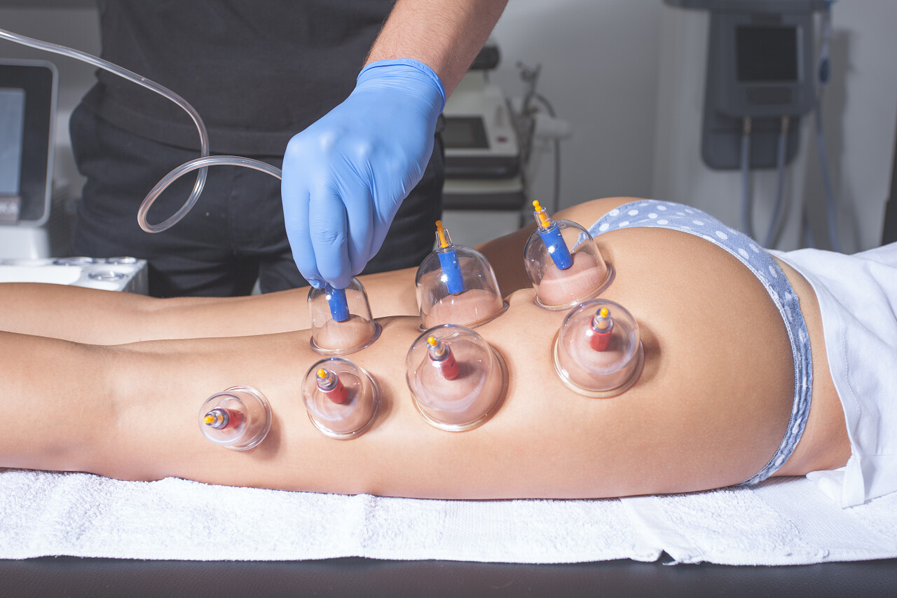 拔罐的女人中医养生拔罐