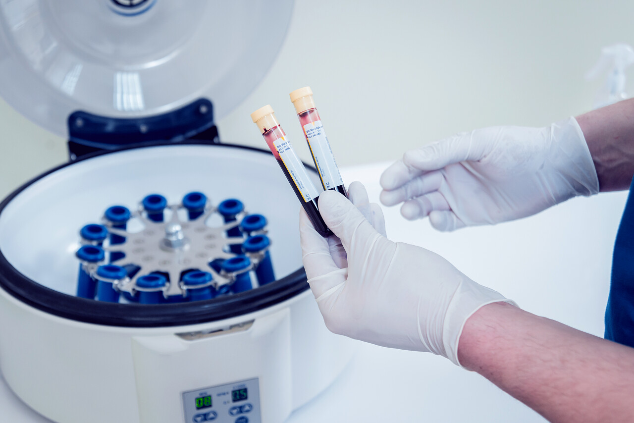 血小板丰富血浆制手里拿着血的管子三.普查.