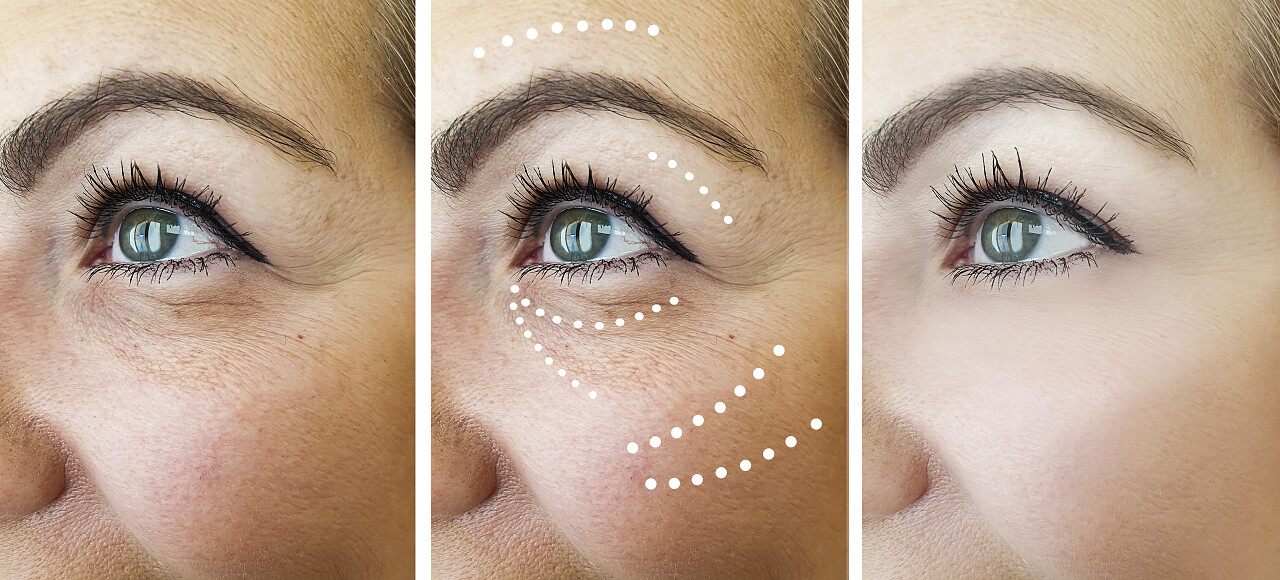 女性在拼贴手术前后的皱纹眼部整形面部抗衰衰老面部整形皮肤暗黄医美抗衰