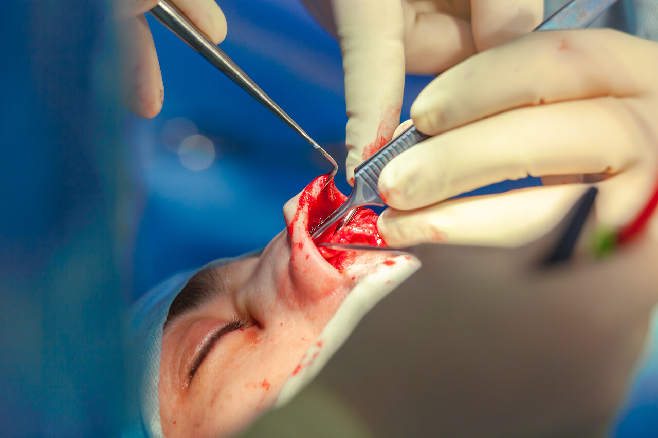 外科医生和他的助手执行整容手术在医院手术室的鼻子上