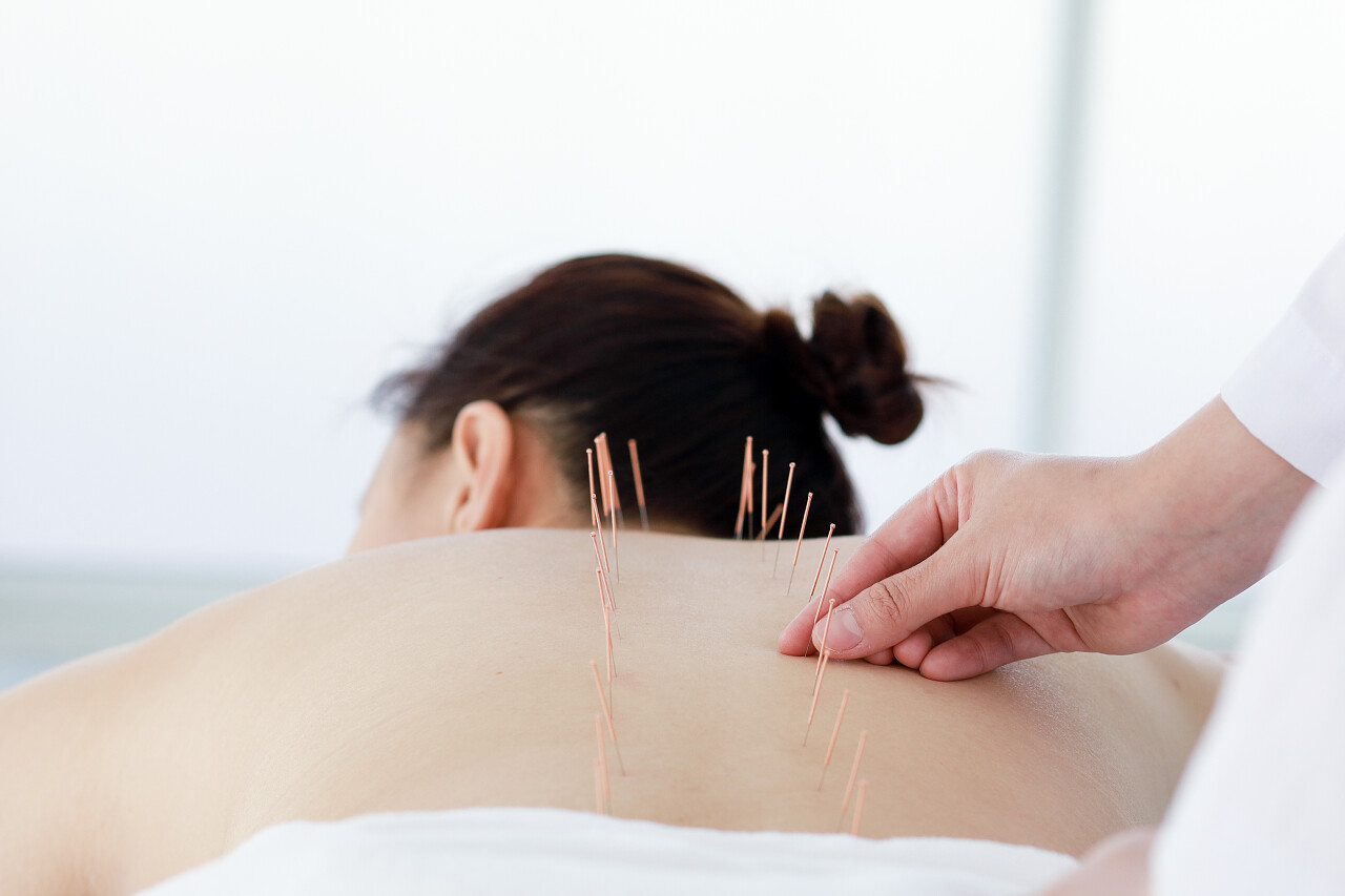 进行针灸治疗的医生的手