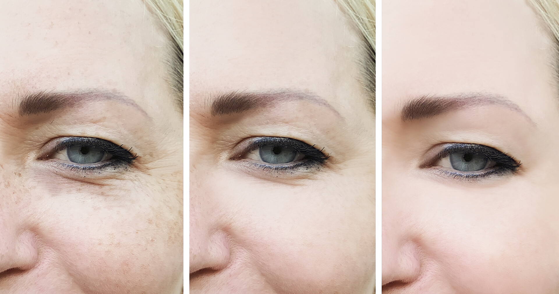 女人美容过程图妇女脸上的皱纹, 前后的色素沉着