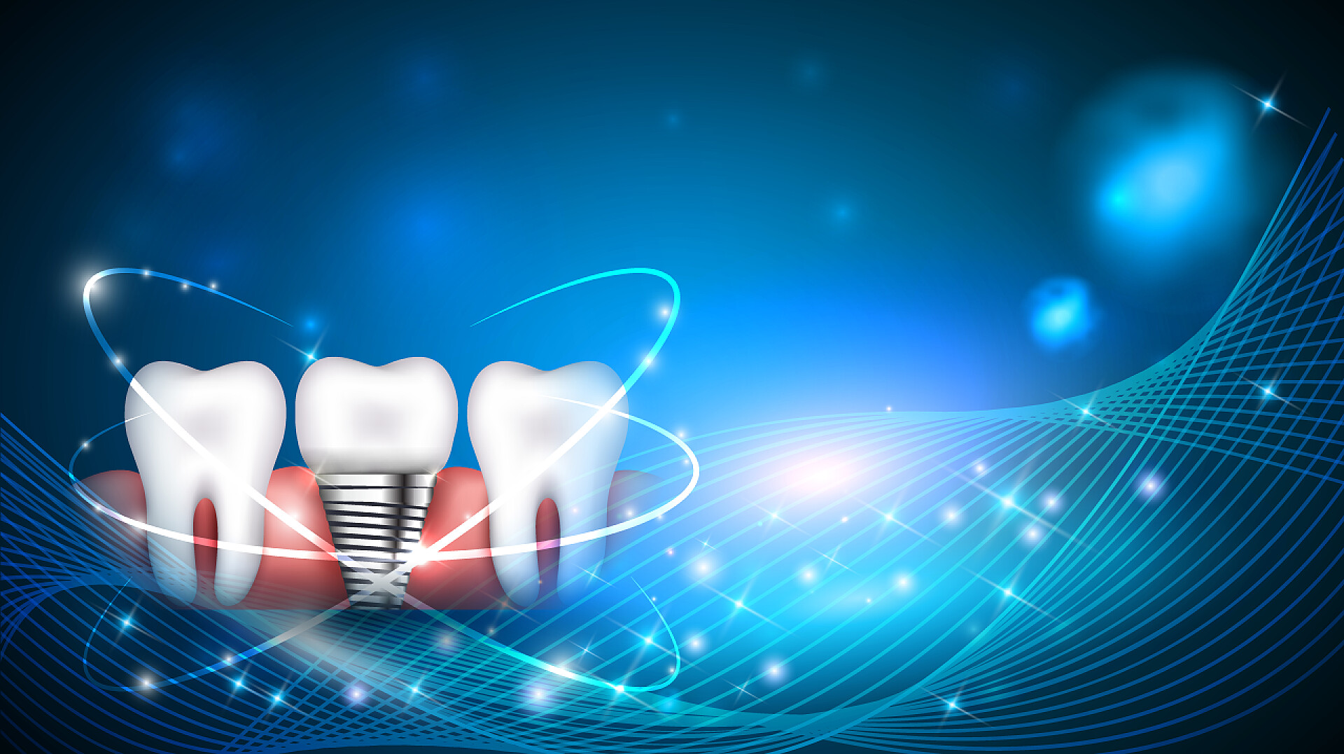 蓝色发光背景三颗牙齿种植牙概念