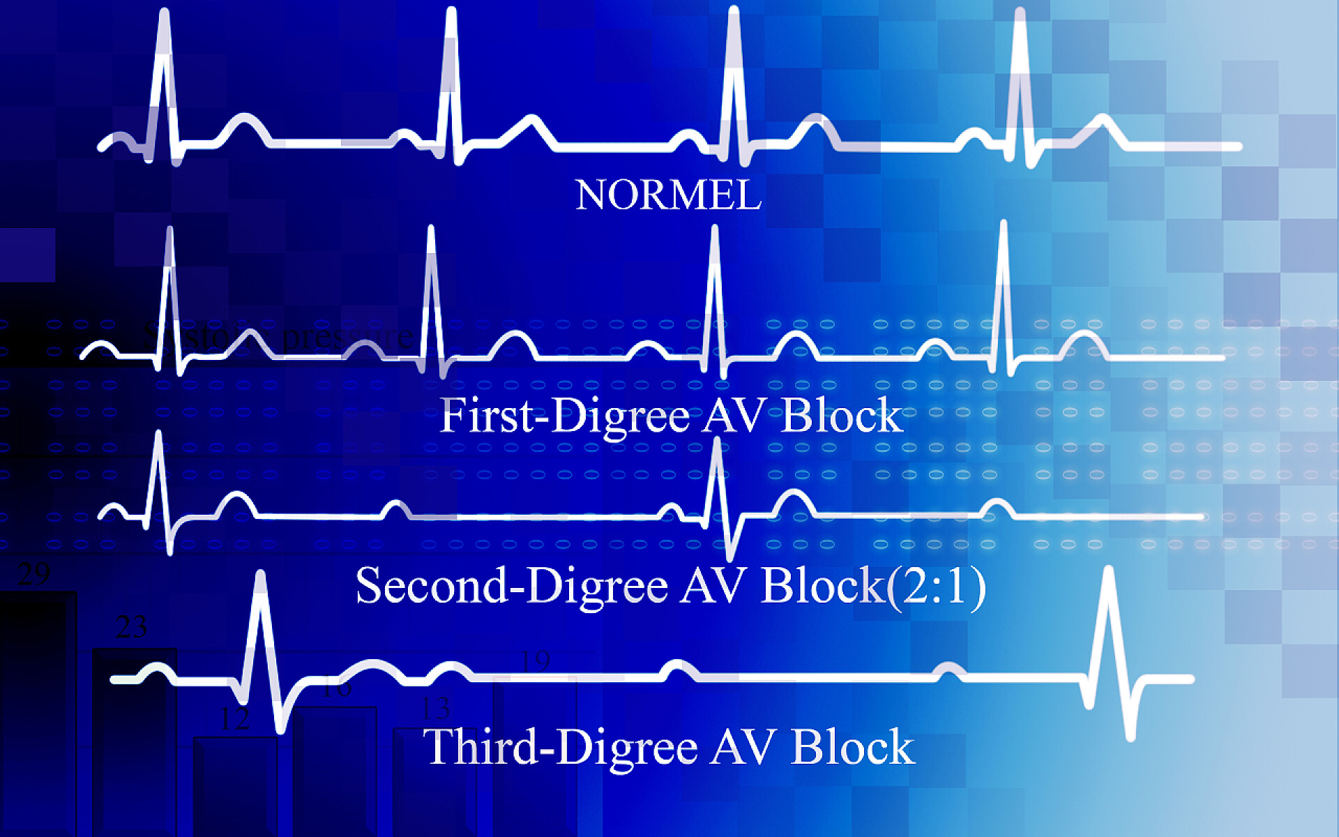 蓝色背景上的冠状动脉疾病曲线所有度房室传导阻滞的冠状动脉疾病