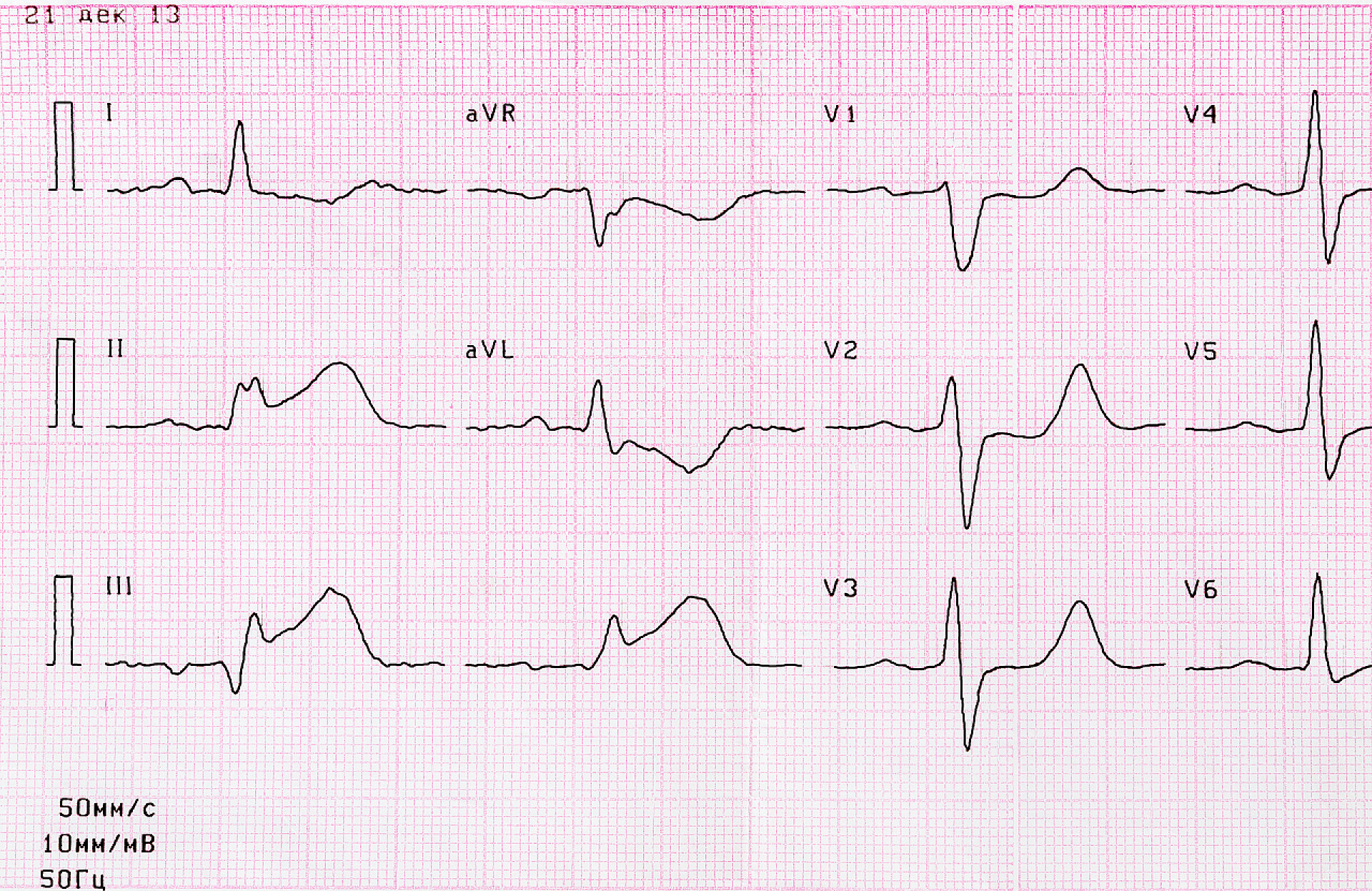 心肌梗死急性期的典型心电图与心肌梗死急性期心电图磁带  