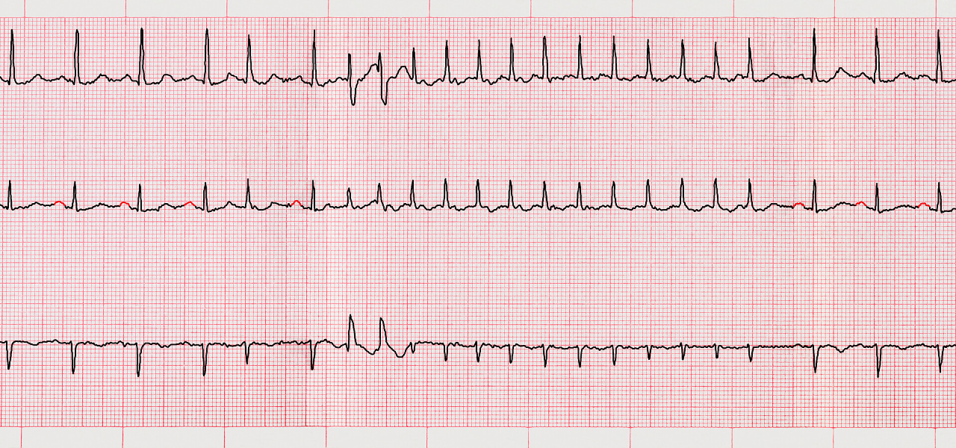 心电图室上性心律失常和短阵发心房颤动心电图室上性心律失常和短阵发心房颤动