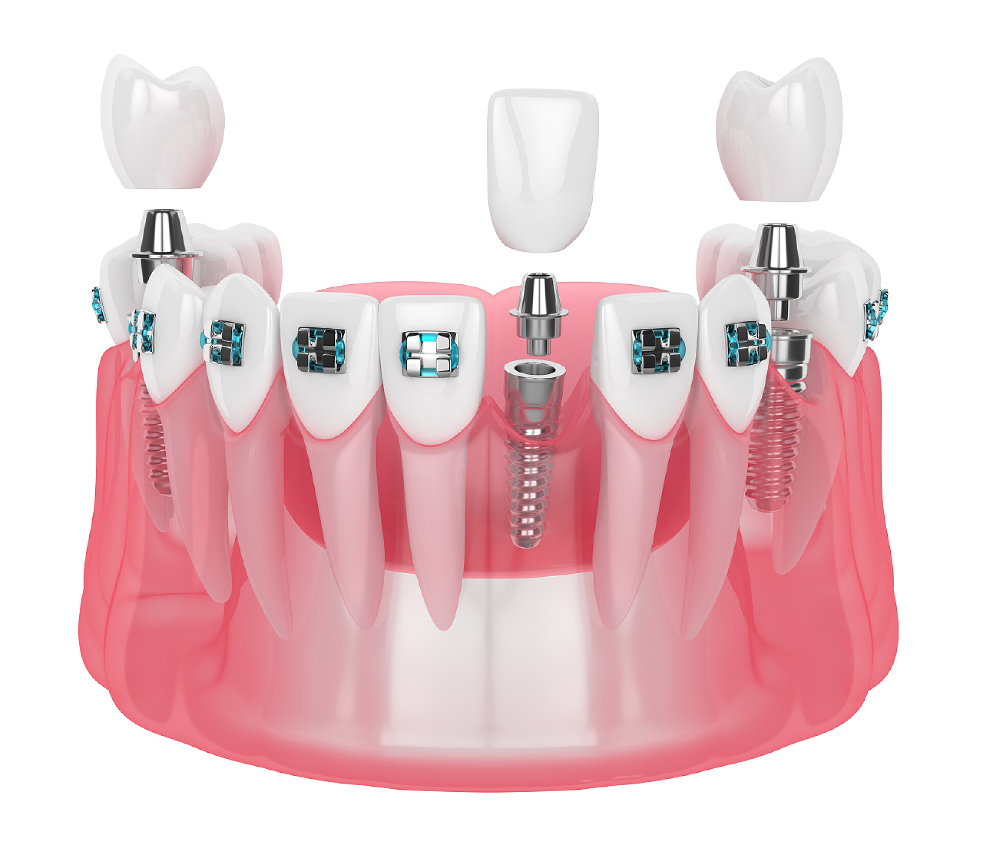 白色背景上矫正的牙齿模型带植入物和正畸支架的颌骨3d渲染