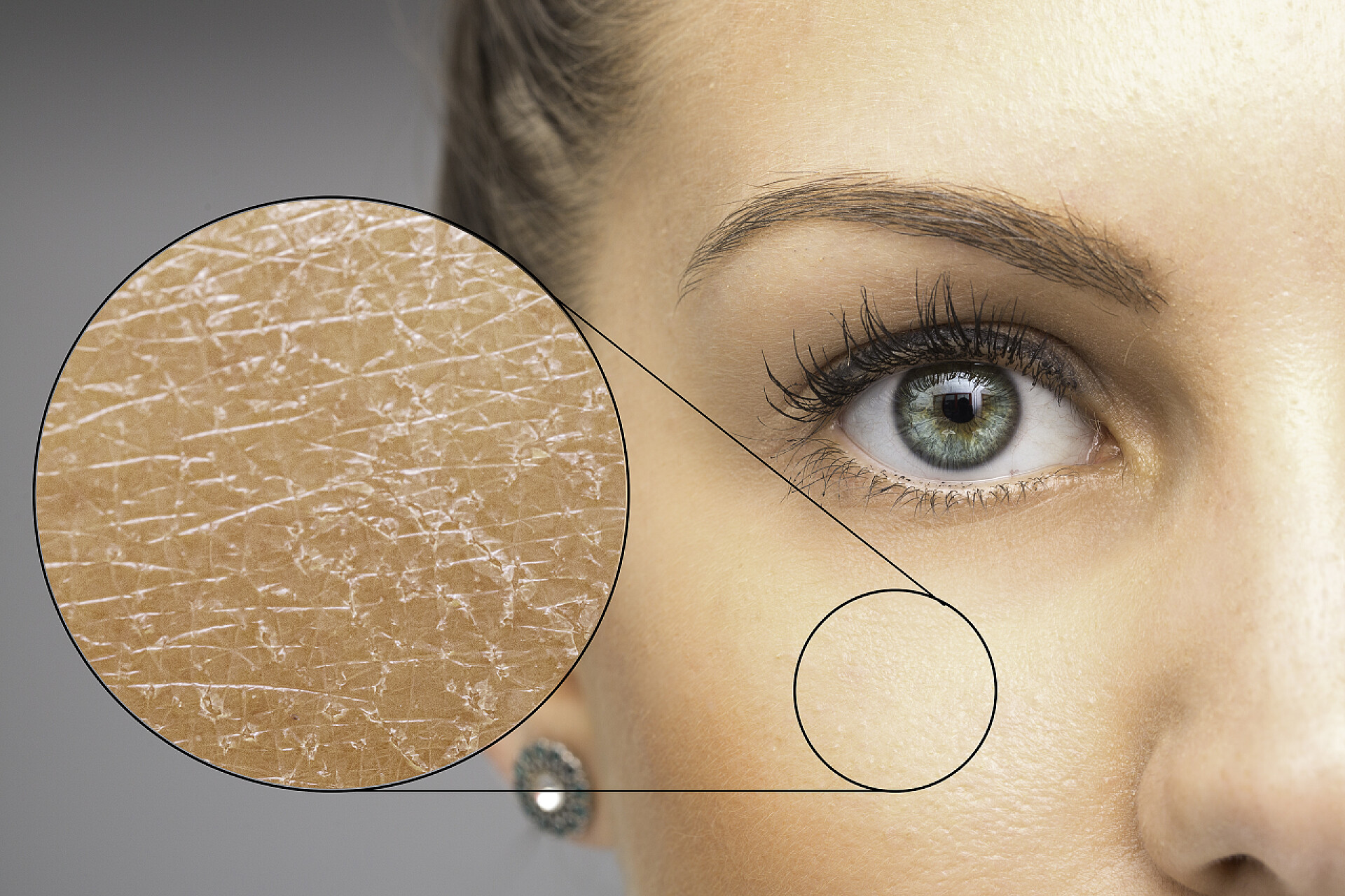 女人脸部肤质特写在一个美丽的高加索女孩的面颊上可见一个放大的宏观细节圆圈，仔细检查皮肤会发现皮肤干燥和片状，需要皮肤科医生.