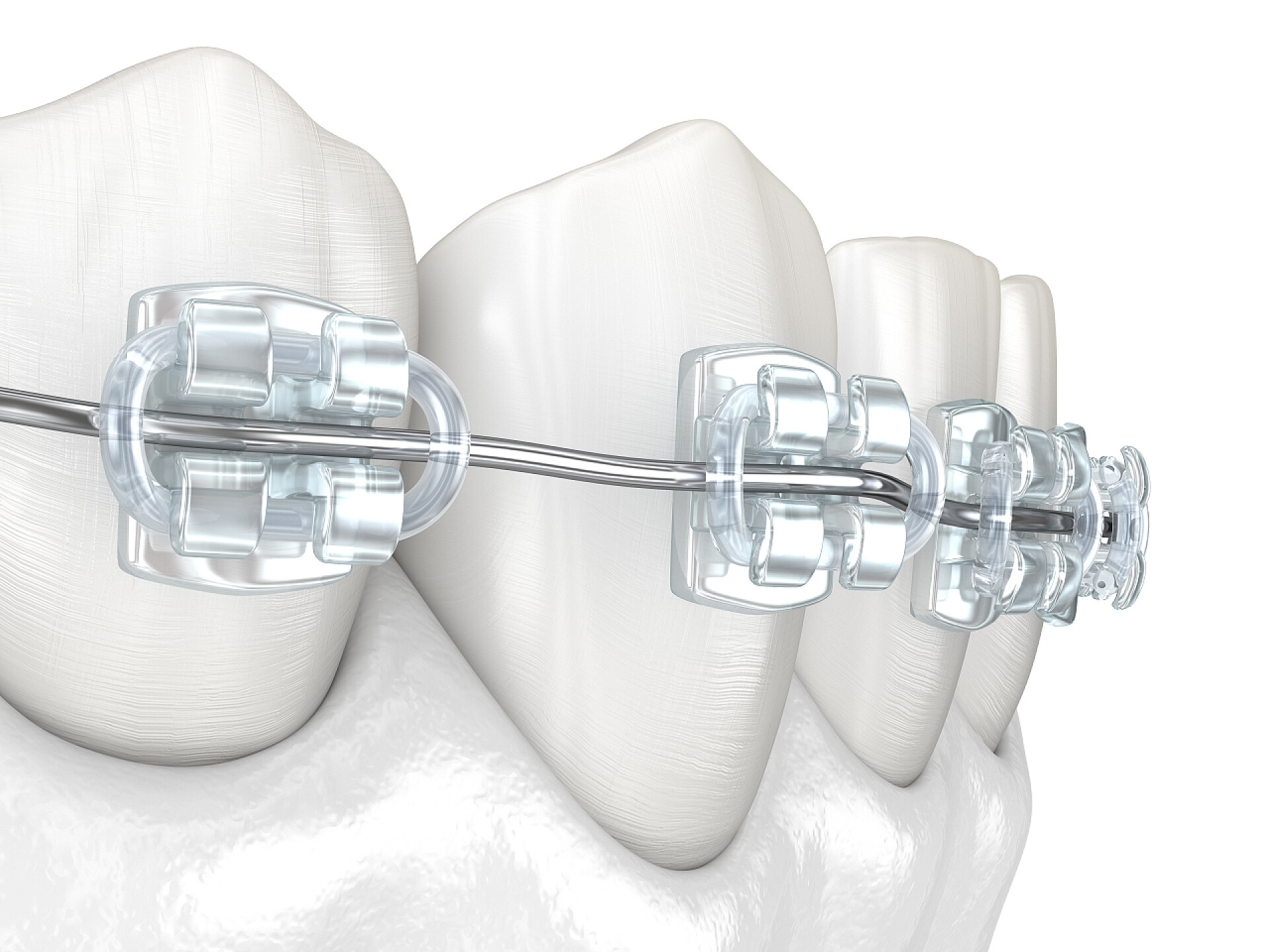 牙齿矫正特写牙齿和清晰的支撑。医学上准确的牙科3D图像