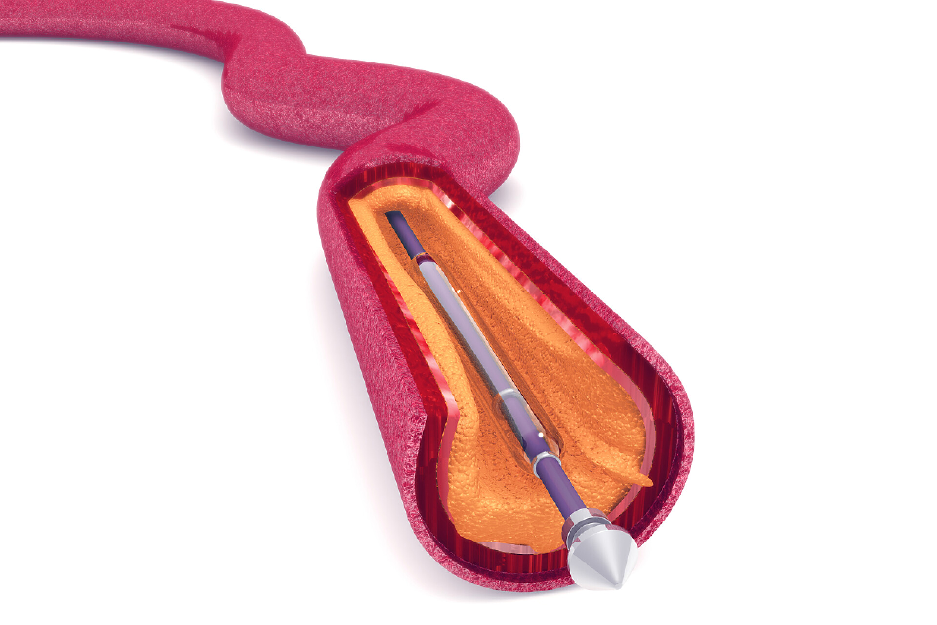 3d视觉下的血管视图气球可伸缩支架。解剖学概念