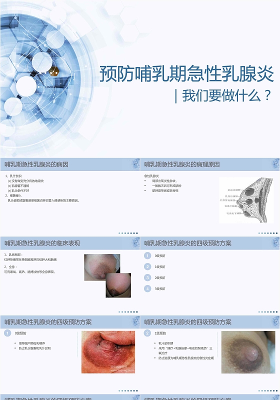 蓝色简约扁平预防哺乳期急性乳腺炎措施科普PPT模版