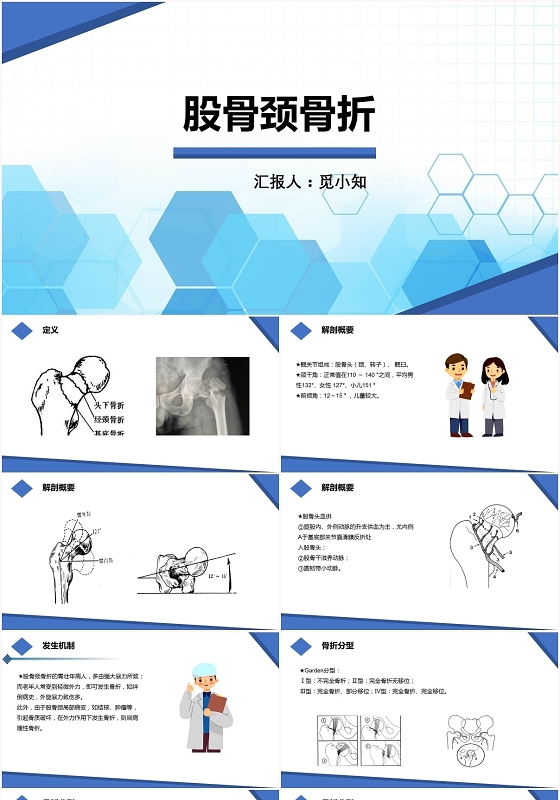 蓝色扁平股骨颈骨折护理查房股骨颈骨折PPT模板