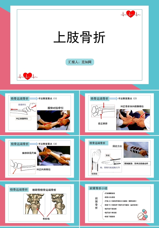 粉色骨折上肢骨折护理查房