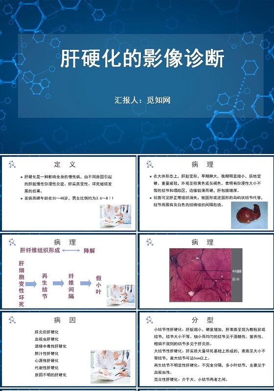 深蓝色简约风肝硬化的影像诊断医疗护理PPT模板肝硬化患者护理查房