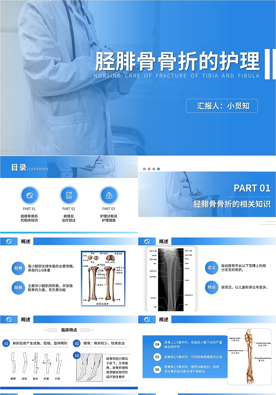 简约胫腓骨骨折护理查房PPT模板宣传PPT动态PPT