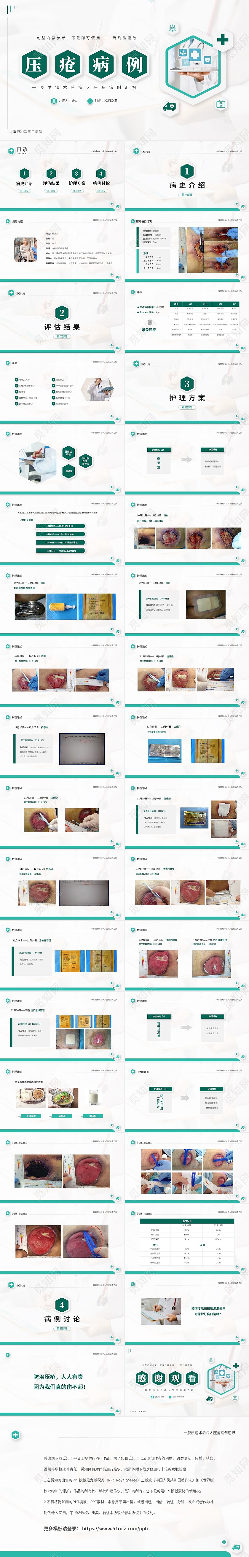 绿色清新微粒医疗胶质瘤术后病人压疮病例汇报课件PPT